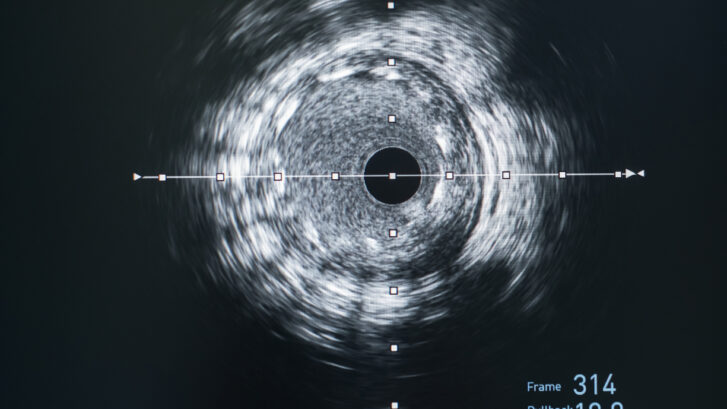 Ivus 727x409 1