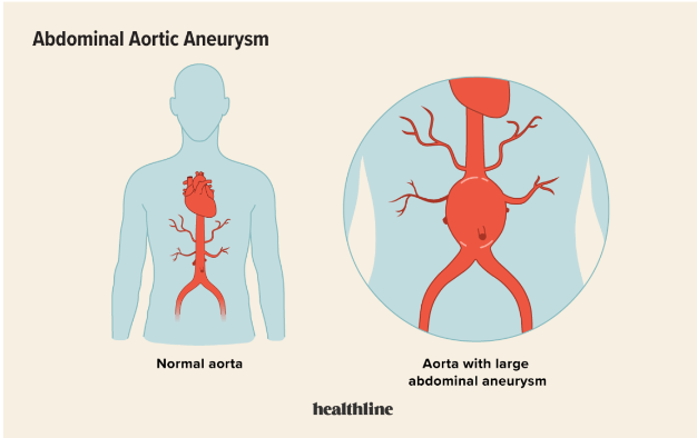 Anevrism abdominal