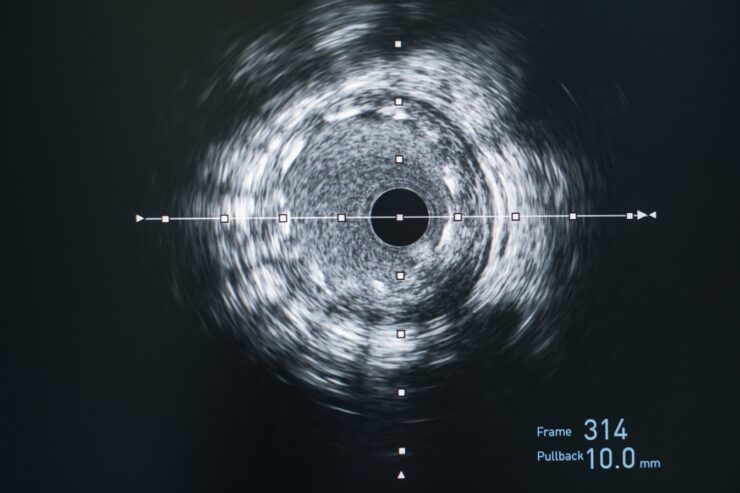 Ultrasonografia intravasculara IVUS 740x493 1