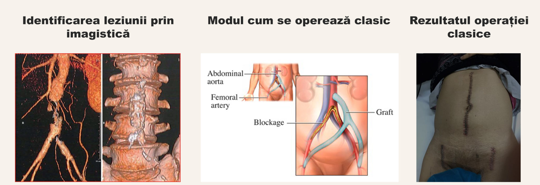 Operația Clasică — Bypass Aorto-Bifemural