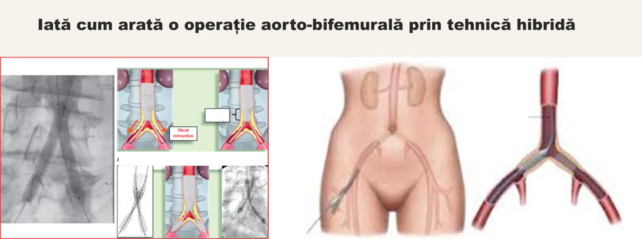 Iată cum arată o operație aorto-bifemurală prin tehnică hibridă