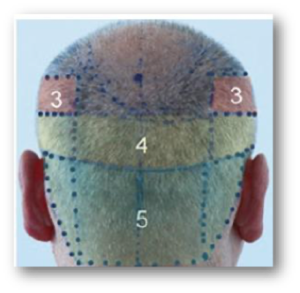 Tehnica standard NeoGraft
