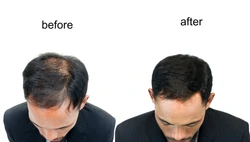 Scalele alopeciei